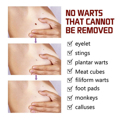 Professional Skin Tag & Mole Removal Device – Flawless Skin At Home